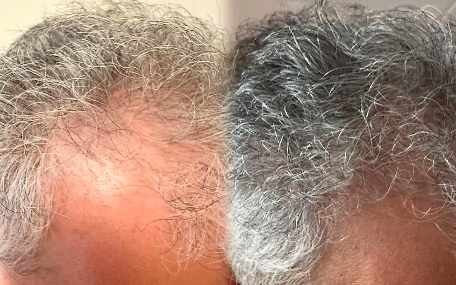 Voor en na een haar- en hoofdhuidbehandeling: links dun haar met zichtbare hoofdhuid bij de haarlijn, rechts voller haar op dezelfde plek