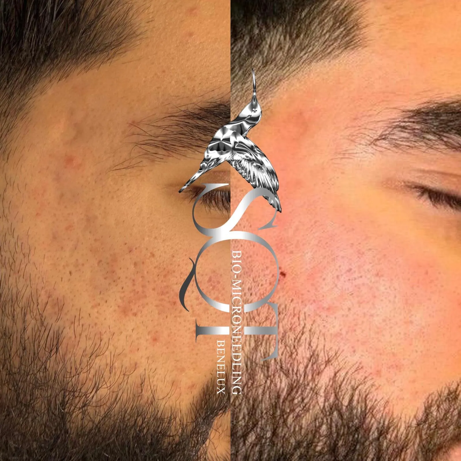 Voor en na SQT Biomicroneedling: links de huid met acne en onzuiverheden, rechts dezelfde huid na de behandeling, nog wat rood